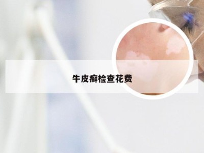 牛皮癣检查花费