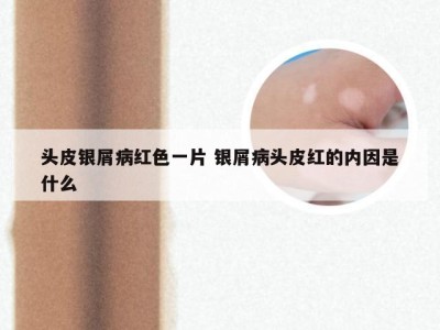 头皮银屑病红色一片 银屑病头皮红的内因是什么