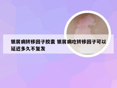 银屑病转移因子胶囊 银屑病吃转移因子可以延迟多久不复发