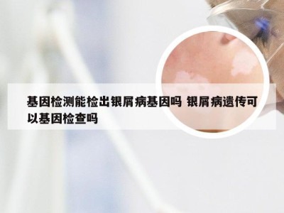 基因检测能检出银屑病基因吗 银屑病遗传可以基因检查吗