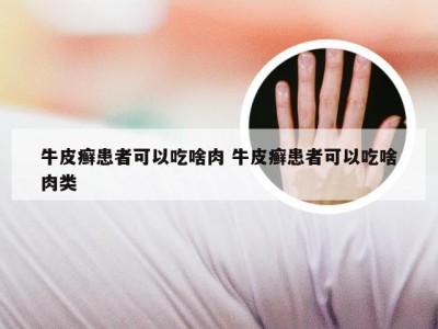 牛皮癣患者可以吃啥肉 牛皮癣患者可以吃啥肉类