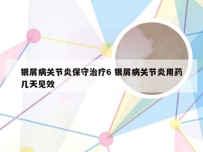 银屑病关节炎保守治疗6 银屑病关节炎用药几天见效