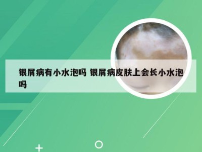 银屑病有小水泡吗 银屑病皮肤上会长小水泡吗