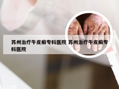 苏州治疗牛皮癣专科医院 苏州治疗牛皮癣专科医院