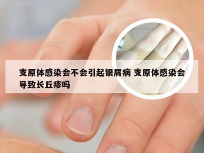 支原体感染会不会引起银屑病 支原体感染会导致长丘疹吗