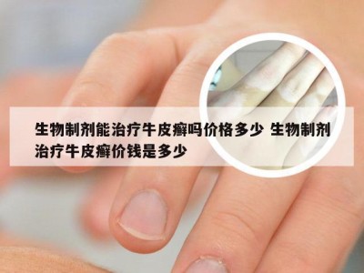 生物制剂能治疗牛皮癣吗价格多少 生物制剂治疗牛皮癣价钱是多少