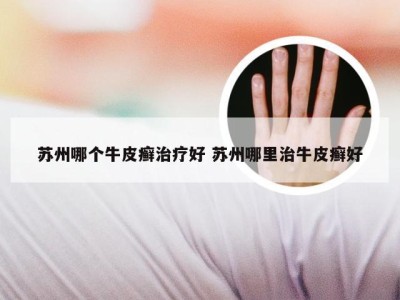 苏州哪个牛皮癣治疗好 苏州哪里治牛皮癣好