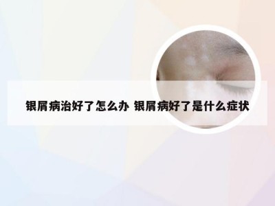 银屑病治好了怎么办 银屑病好了是什么症状