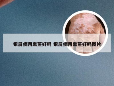 银屑病用熏蒸好吗 银屑病用熏蒸好吗图片