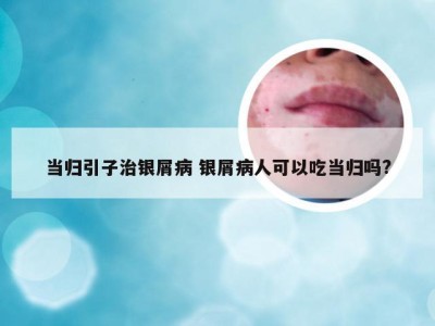 当归引子治银屑病 银屑病人可以吃当归吗?