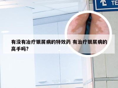 有没有冶疗银屑病的特效药 有治疗银屑病的高手吗?