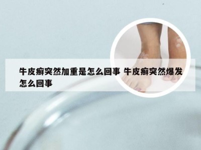 牛皮癣突然加重是怎么回事 牛皮癣突然爆发怎么回事