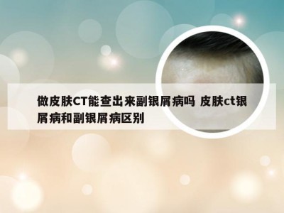 做皮肤CT能查出来副银屑病吗 皮肤ct银屑病和副银屑病区别