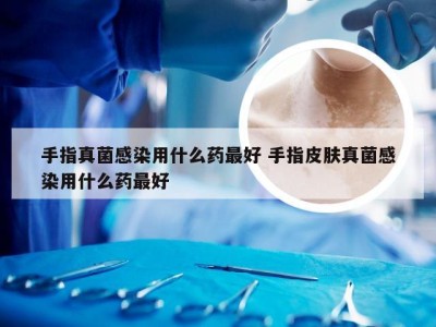 手指真菌感染用什么药最好 手指皮肤真菌感染用什么药最好