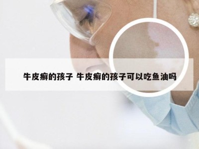牛皮癣的孩子 牛皮癣的孩子可以吃鱼油吗