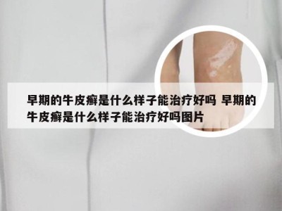 早期的牛皮癣是什么样子能治疗好吗 早期的牛皮癣是什么样子能治疗好吗图片