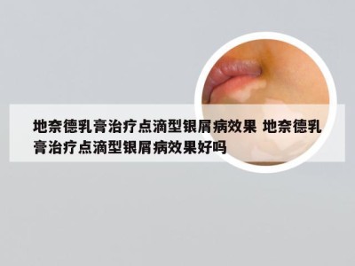 地奈德乳膏治疗点滴型银屑病效果 地奈德乳膏治疗点滴型银屑病效果好吗