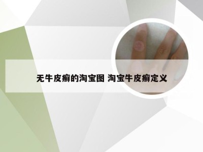 无牛皮癣的淘宝图 淘宝牛皮癣定义