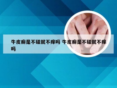 牛皮癣是不碰就不痒吗 牛皮癣是不碰就不痒吗