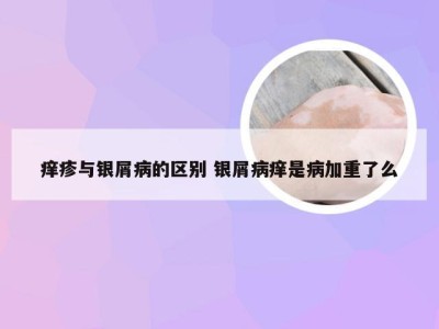 痒疹与银屑病的区别 银屑病痒是病加重了么