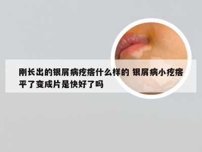 刚长出的银屑病疙瘩什么样的 银屑病小疙瘩平了变成片是快好了吗