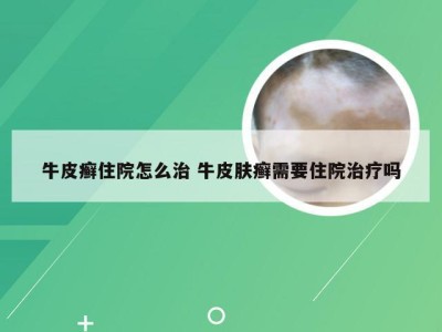 牛皮癣住院怎么治 牛皮肤癣需要住院治疗吗