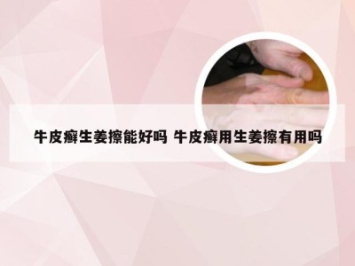 牛皮癣生姜擦能好吗 牛皮癣用生姜擦有用吗