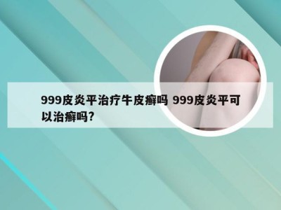 999皮炎平治疗牛皮癣吗 999皮炎平可以治癣吗?