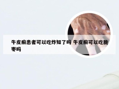 牛皮癣患者可以吃炸知了吗 牛皮癣可以吃脆枣吗