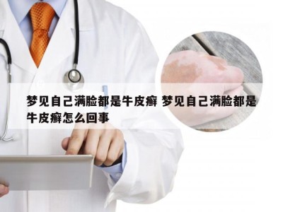 梦见自己满脸都是牛皮癣 梦见自己满脸都是牛皮癣怎么回事