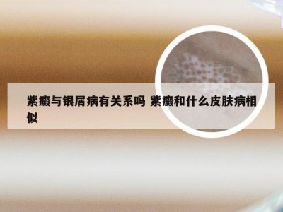 紫癜与银屑病有关系吗 紫癜和什么皮肤病相似