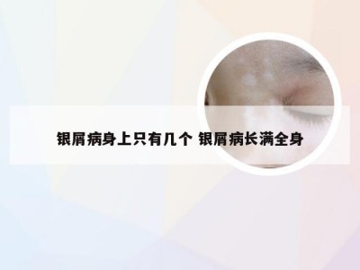 银屑病身上只有几个 银屑病长满全身