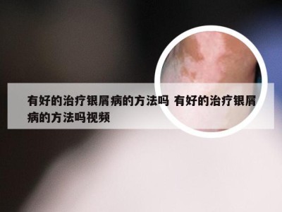 有好的治疗银屑病的方法吗 有好的治疗银屑病的方法吗视频