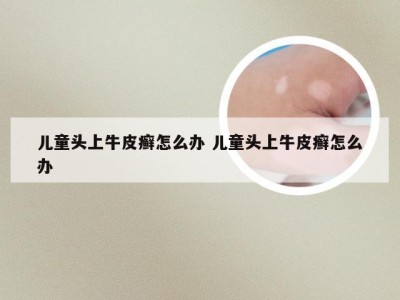儿童头上牛皮癣怎么办 儿童头上牛皮癣怎么办