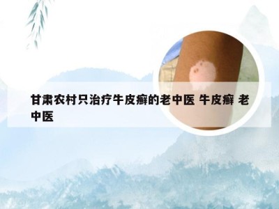 甘肃农村只治疗牛皮癣的老中医 牛皮癣 老中医