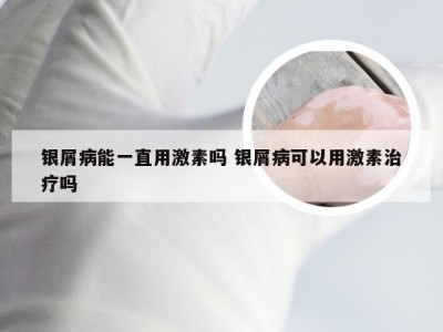 银屑病能一直用激素吗 银屑病可以用激素治疗吗