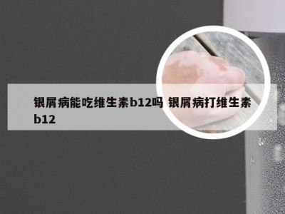 银屑病能吃维生素b12吗 银屑病打维生素b12
