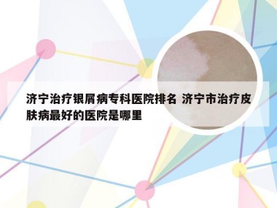 济宁治疗银屑病专科医院排名 济宁市治疗皮肤病最好的医院是哪里