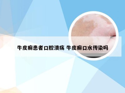 牛皮癣患者口腔溃疡 牛皮癣口水传染吗