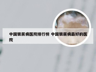 中国银屑病医院排行榜 中国银屑病最好的医院