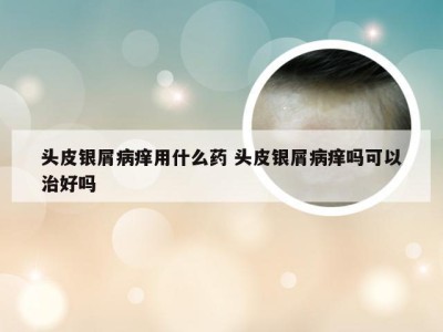 头皮银屑病痒用什么药 头皮银屑病痒吗可以治好吗