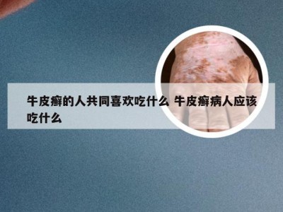 牛皮癣的人共同喜欢吃什么 牛皮癣病人应该吃什么