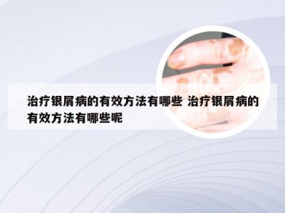 治疗银屑病的有效方法有哪些 治疗银屑病的有效方法有哪些呢