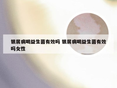 银屑病喝益生菌有效吗 银屑病喝益生菌有效吗女性