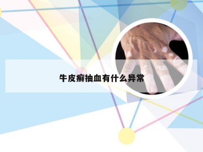 牛皮癣抽血有什么异常