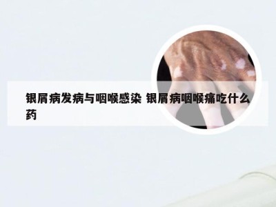 银屑病发病与咽喉感染 银屑病咽喉痛吃什么药