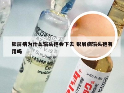 银屑病为什么输头孢会下去 银屑病输头孢有用吗
