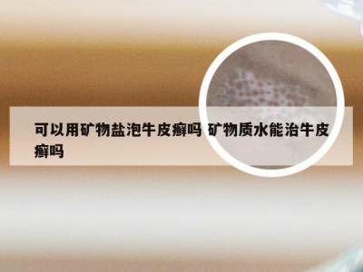 可以用矿物盐泡牛皮癣吗 矿物质水能治牛皮癣吗