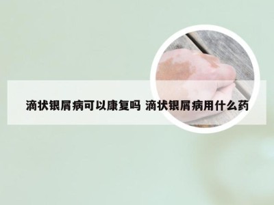 滴状银屑病可以康复吗 滴状银屑病用什么药