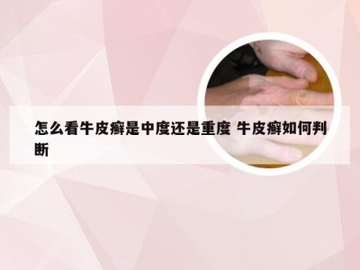 怎么看牛皮癣是中度还是重度 牛皮癣如何判断